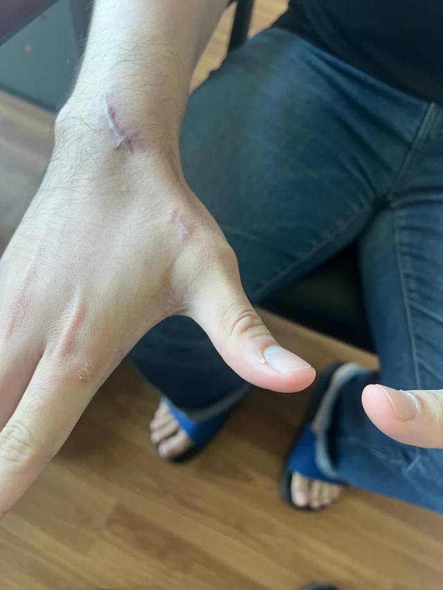 Spontaneous ERL Rupture in a 24-Year-Old
