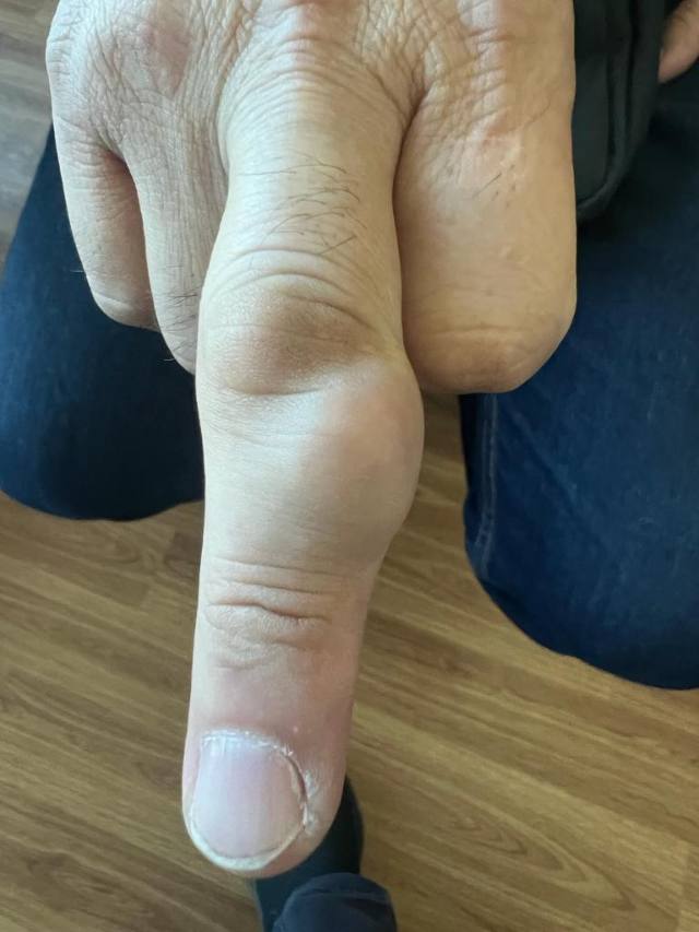 Giant Cell Tumour of Tendon Sheath