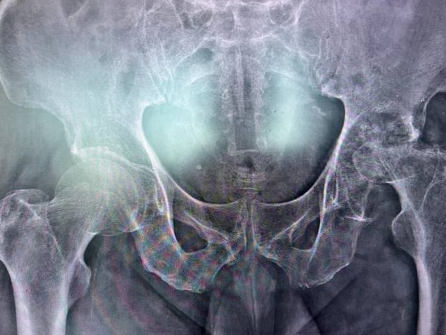 Total Hip Replacement