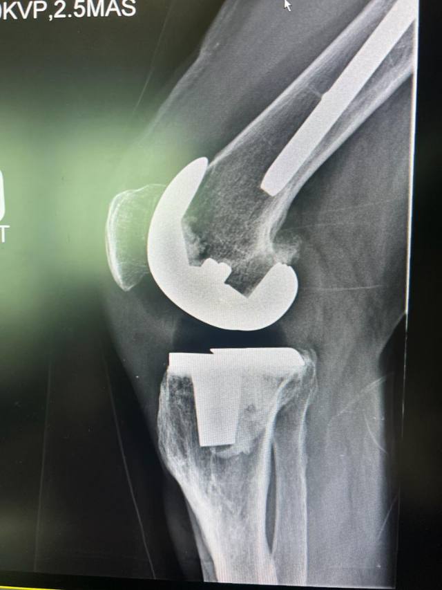 Total Knee Replacement