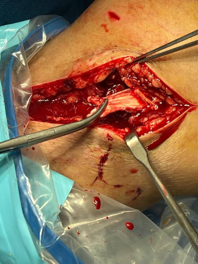 MCL Substance Tear