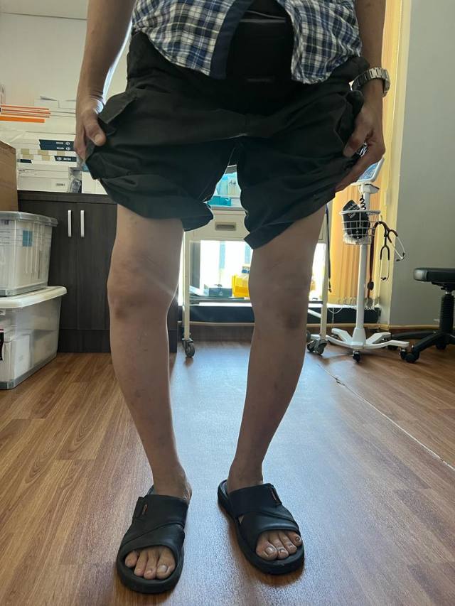 Severe Medial Compartment Osteoarthritis