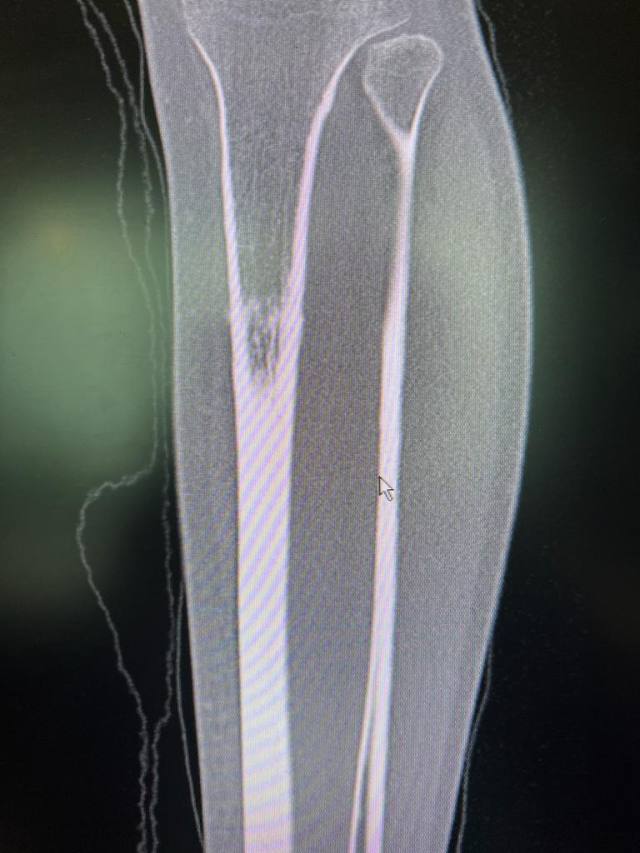 Stress Fracture of the Tibia