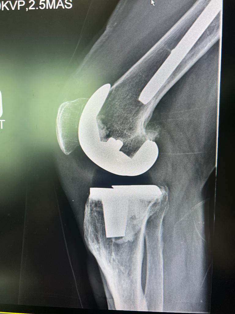 Knee replacement-2