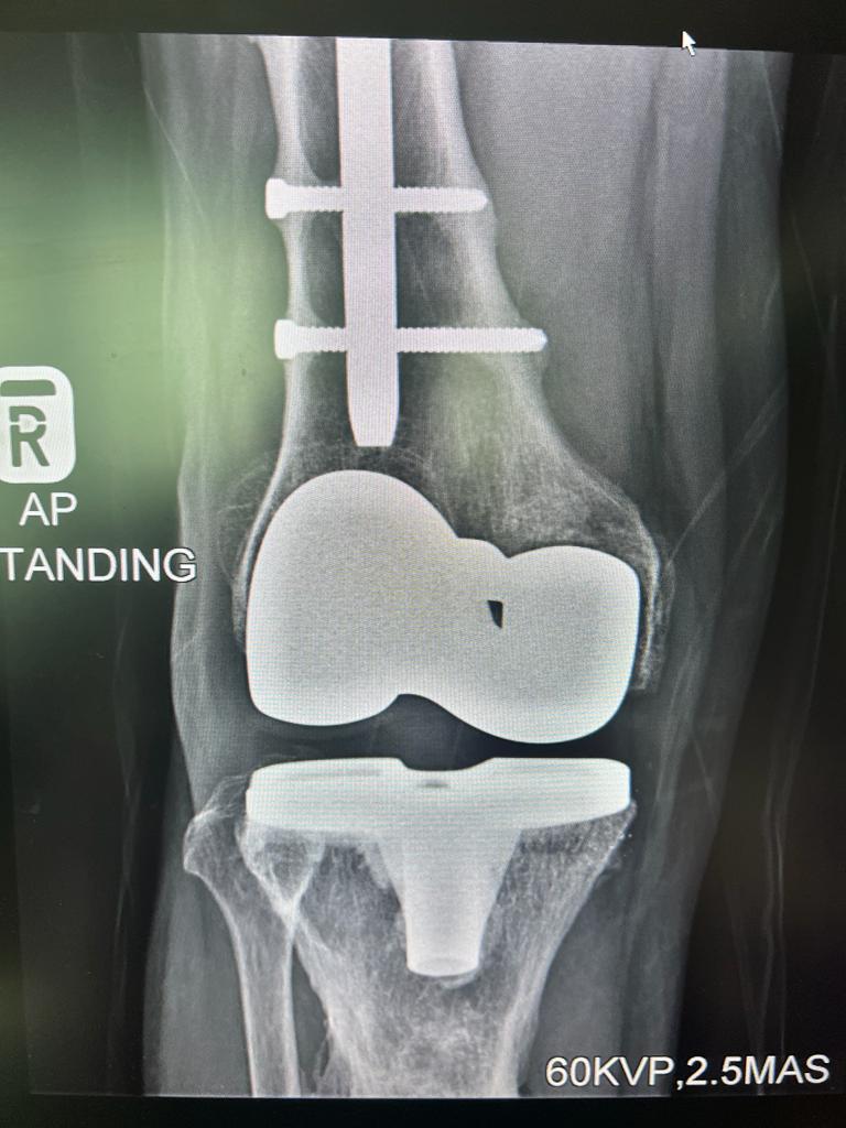 Knee replacement-4