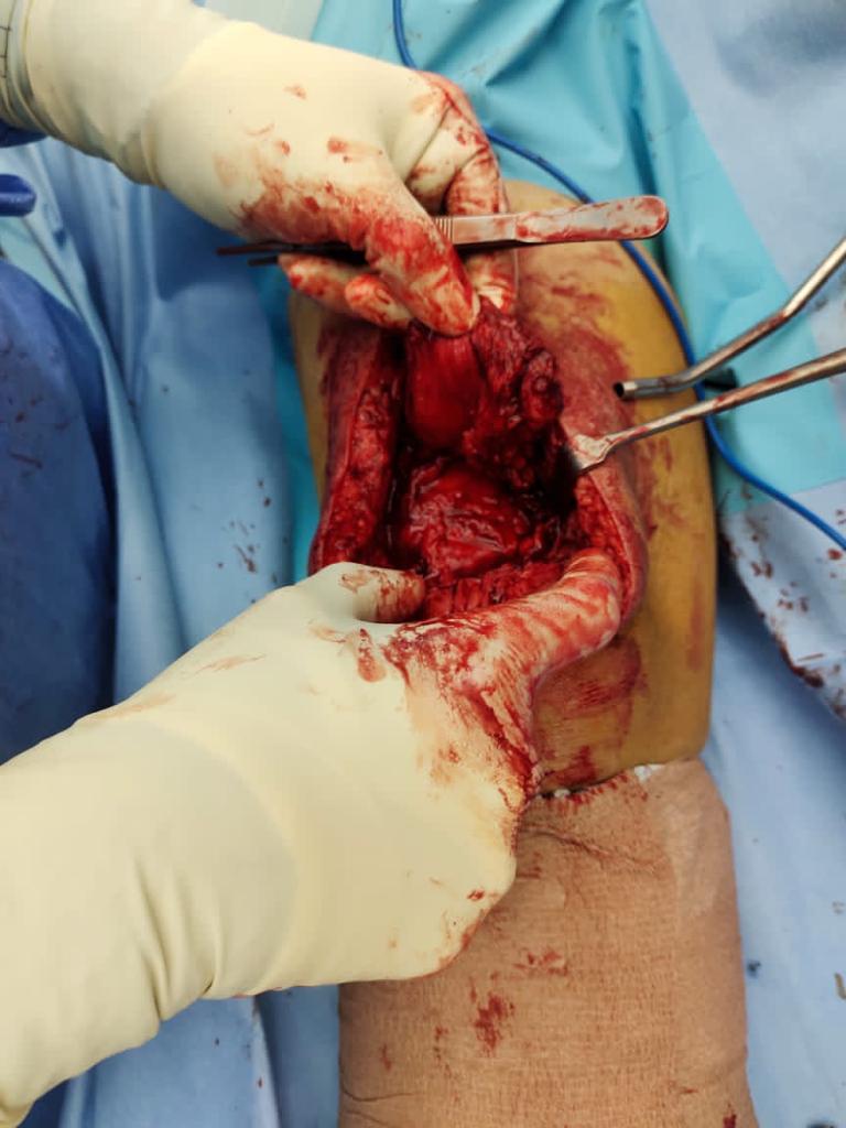 Neglected Quadriceps rupture