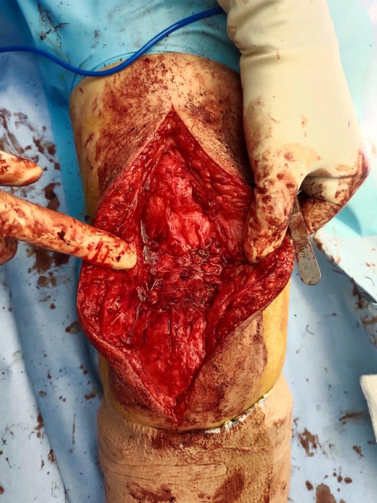 Neglected Quadriceps rupture_5