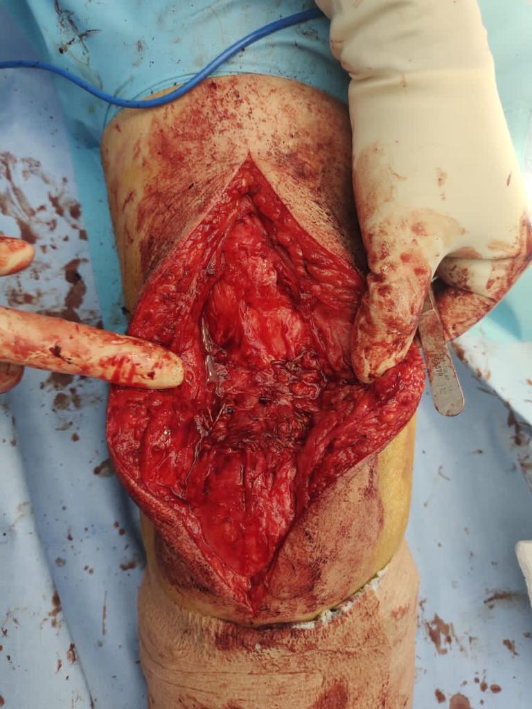 Neglected Quadriceps rupture_6