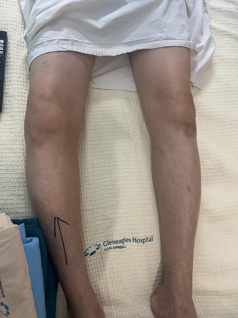 Severe Medical Compartment Osteoarthosis_1