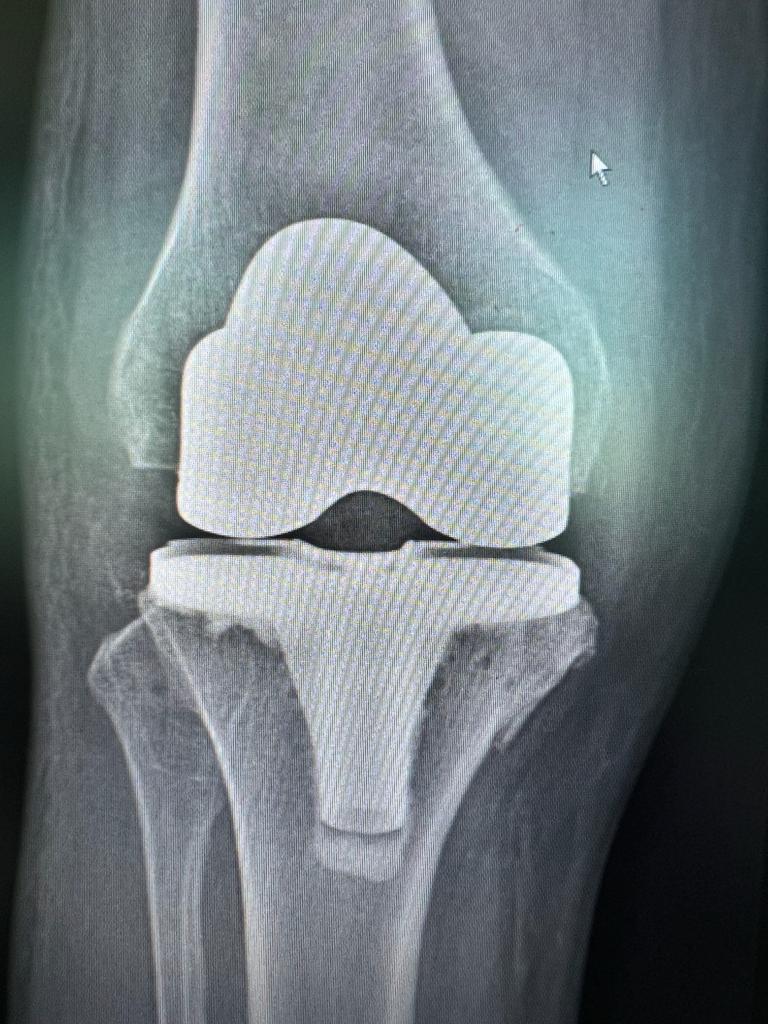 Severe Medical Compartment Osteoarthosis_2