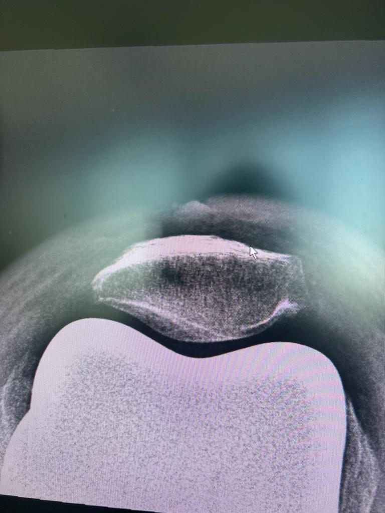 Severe Medical Compartment Osteoarthosis_3