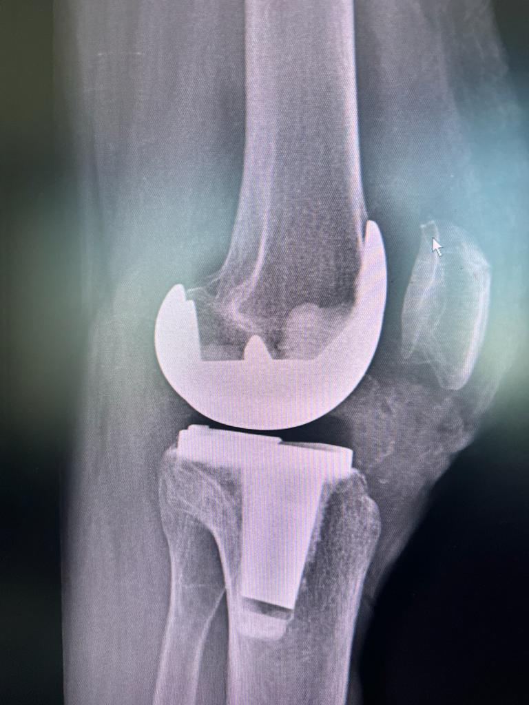 Severe Medical Compartment Osteoarthosis_4