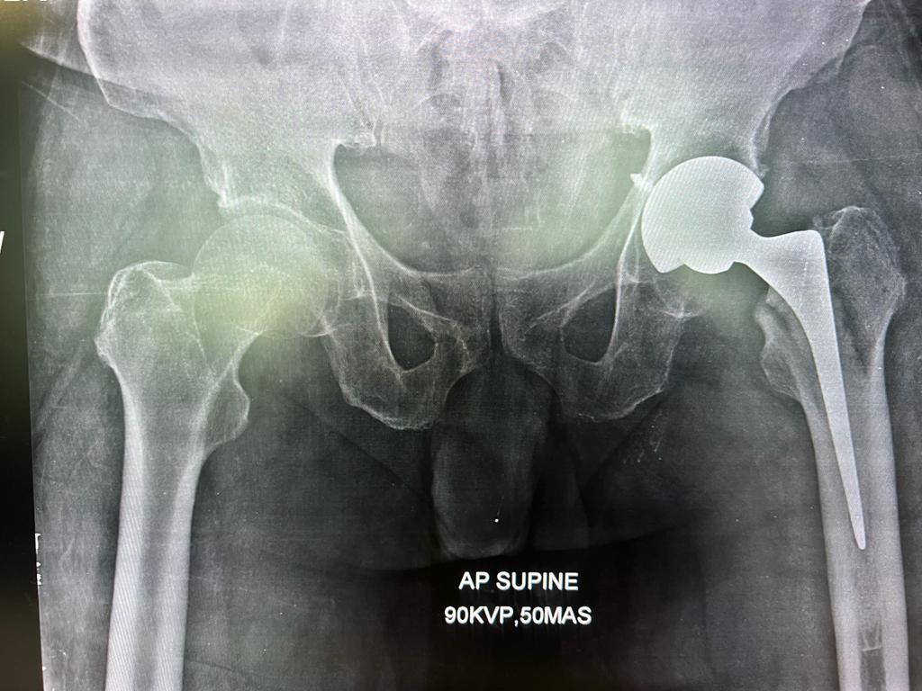 Total Hip Replacement_2