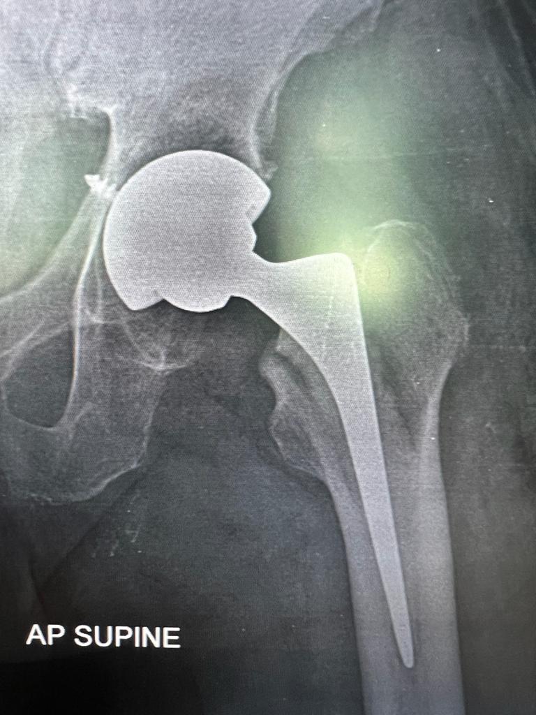 Total Hip Replacement_3