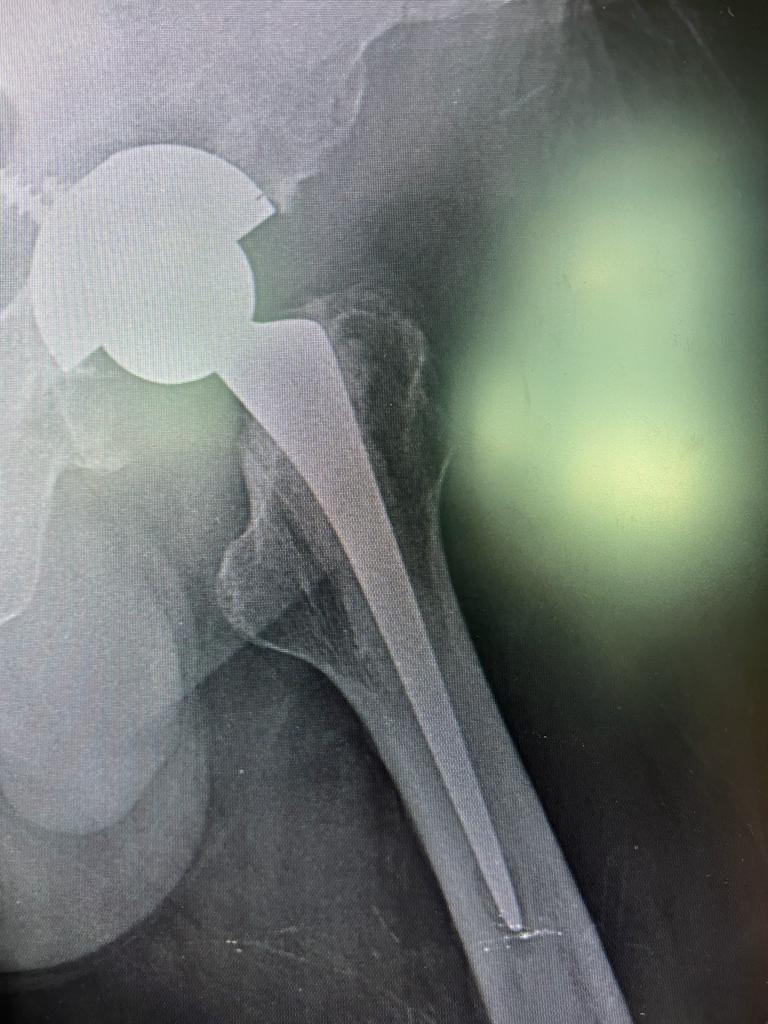 Total Hip Replacement_4