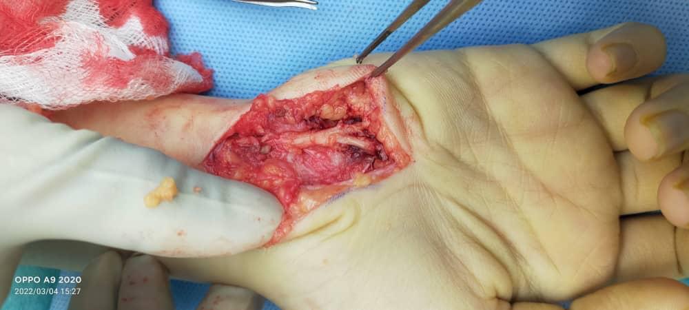 Ulnar nerve decompression in the Guyon’s tunnel