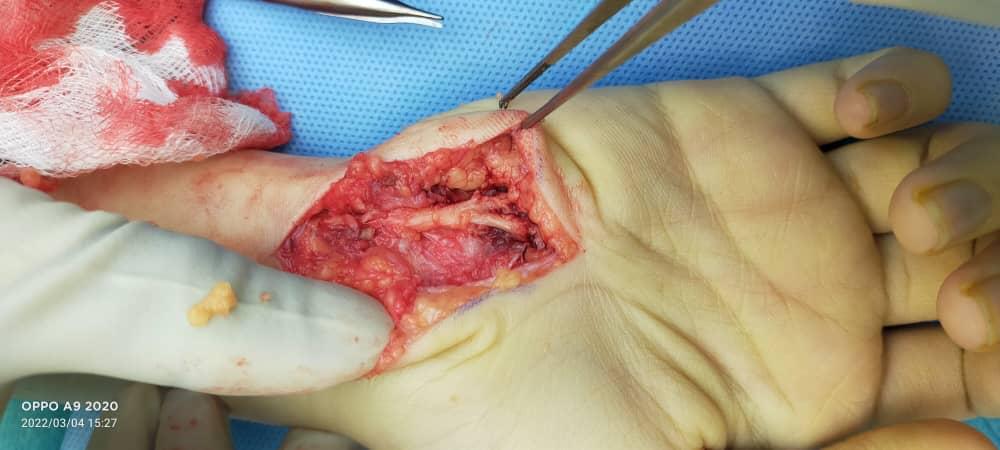 Ulnar nerve decompression in the Guyon’s tunnel_1