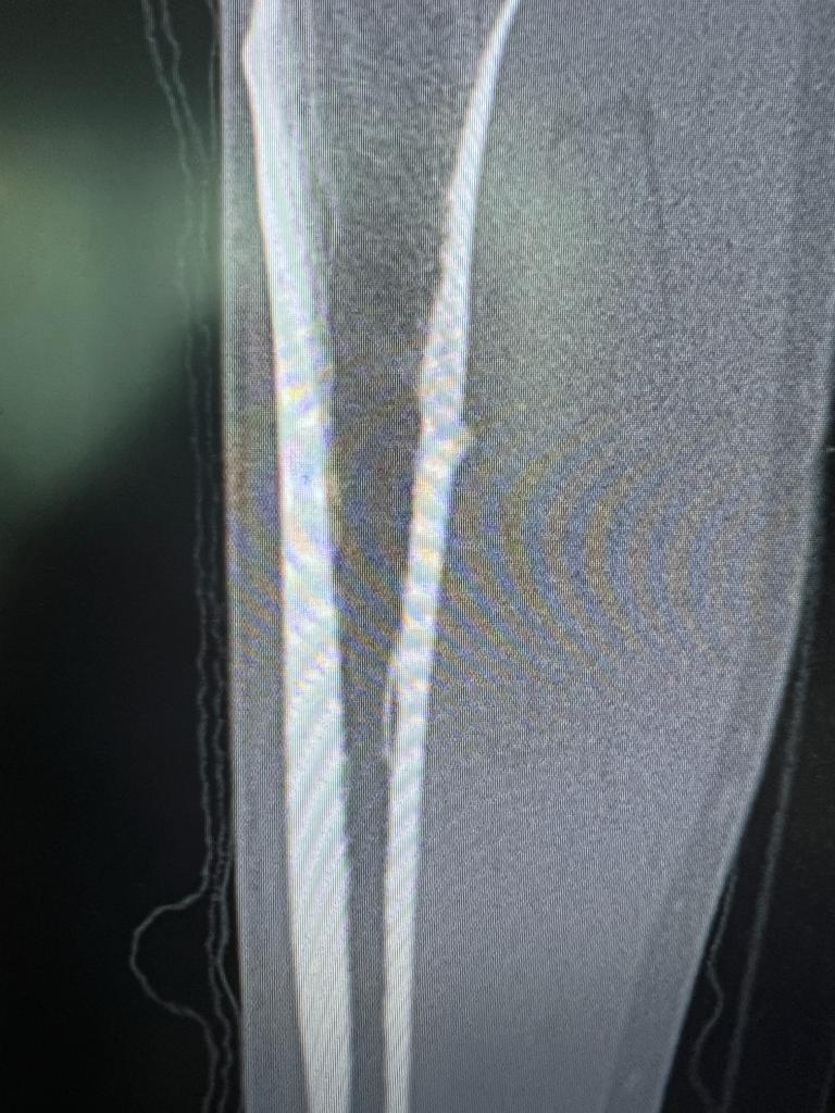 stress fracture of Tibia_2