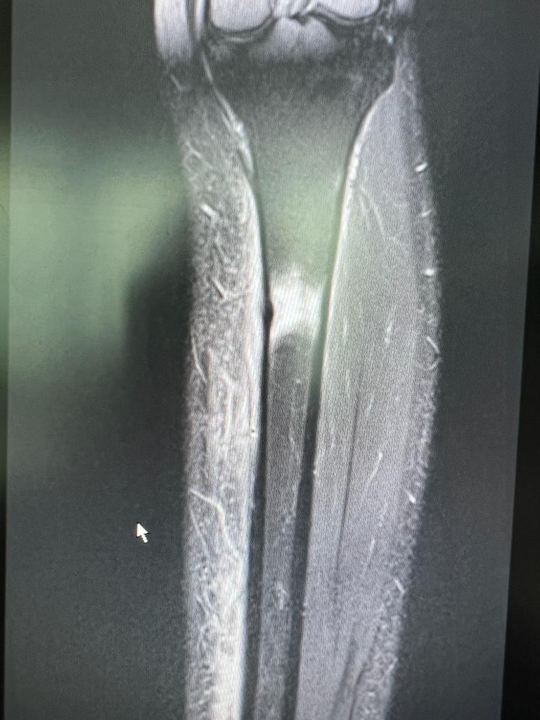 stress fracture of Tibia_3